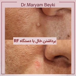 mole-removal.jpg1_