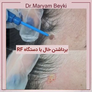 mole-removal.jpg2_