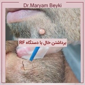 mole-removal.jpg3_