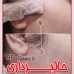 mole-removal.jpg5_