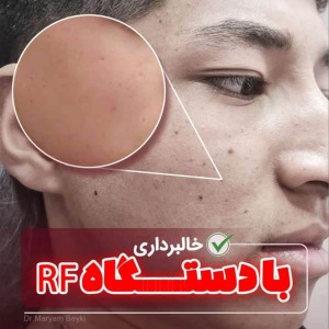 mole-removal.jpg6_