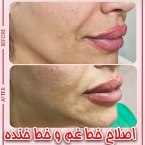 Filler-injection.jpg18