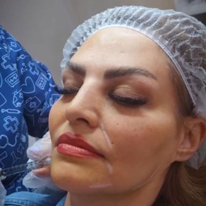 Filler-injection.jpg19