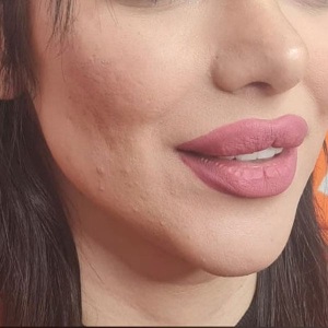 Filler-injection.jpg20