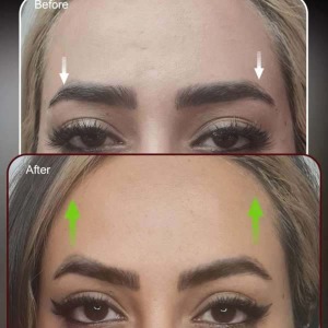 Filler-injection.jpg21