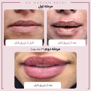 Filler-injection10