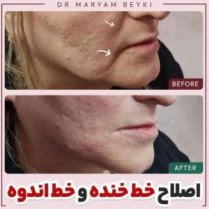 Filler-injection13