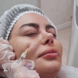 mesogel-Injection-7