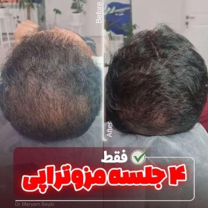 mesotherapy-1
