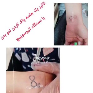 Tattoo-removal-3