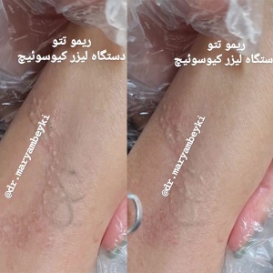 Tattoo-removal-4