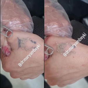 Tattoo-removal-5
