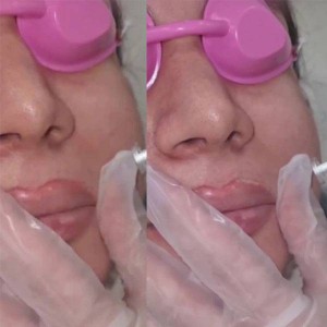 Tattoo-removal-7