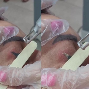Tattoo-removal-8
