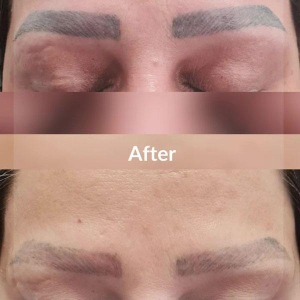 Tattoo-removal1