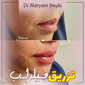 تزریق فیلر - دکتر مریم بیکی
