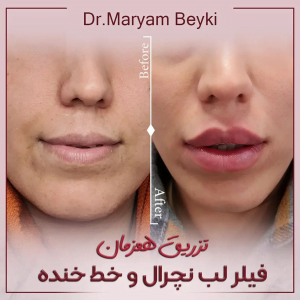 تزریق فیلر - دکتر مریم بیکی