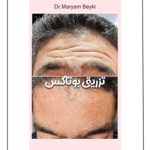 تزریق بوتاکس