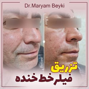 تزریق فیلر خنده - دکتر مریم بیکی