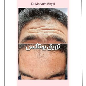 تزریق بوتاکس - دکتر مریم بیکی