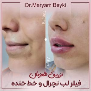 هزینه تزریق فیلر دکتر بیکی ، بهترین دکتر تزریق فیلر در اراک