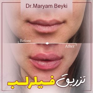 تزریق فیلر لب - دکتر بیکی