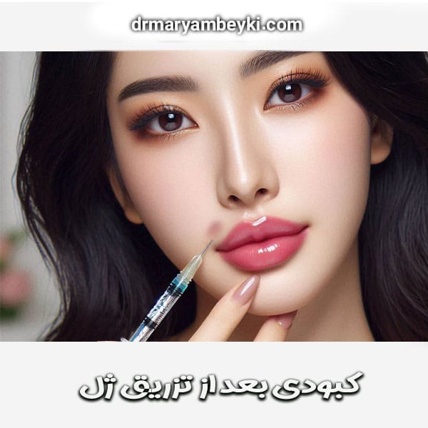 کبودی بعد از تزریق ژل از دکتر مریم بیکی در اراک