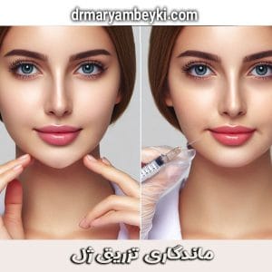 ماندگاری تزریق ژل از دکتر مریم بیکی ، بهترین دکتر تزریق ژل در دلیجان