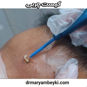 کیست چربی از دکتر مریم بیکی بهترین دکتر زیبایی در دلیجان
