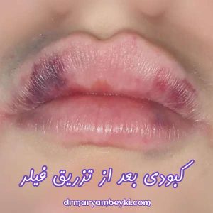 کبودی بعد از تزریق فیلر